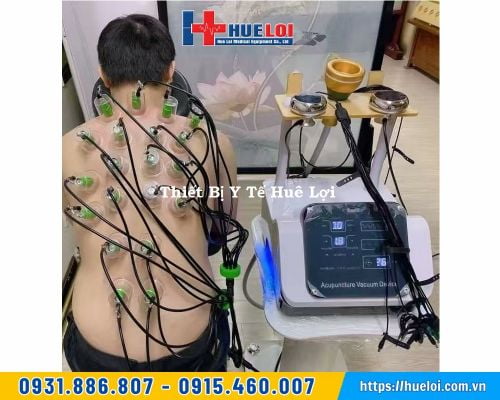 Máy điện châm không kim kèm giác hút điện xung