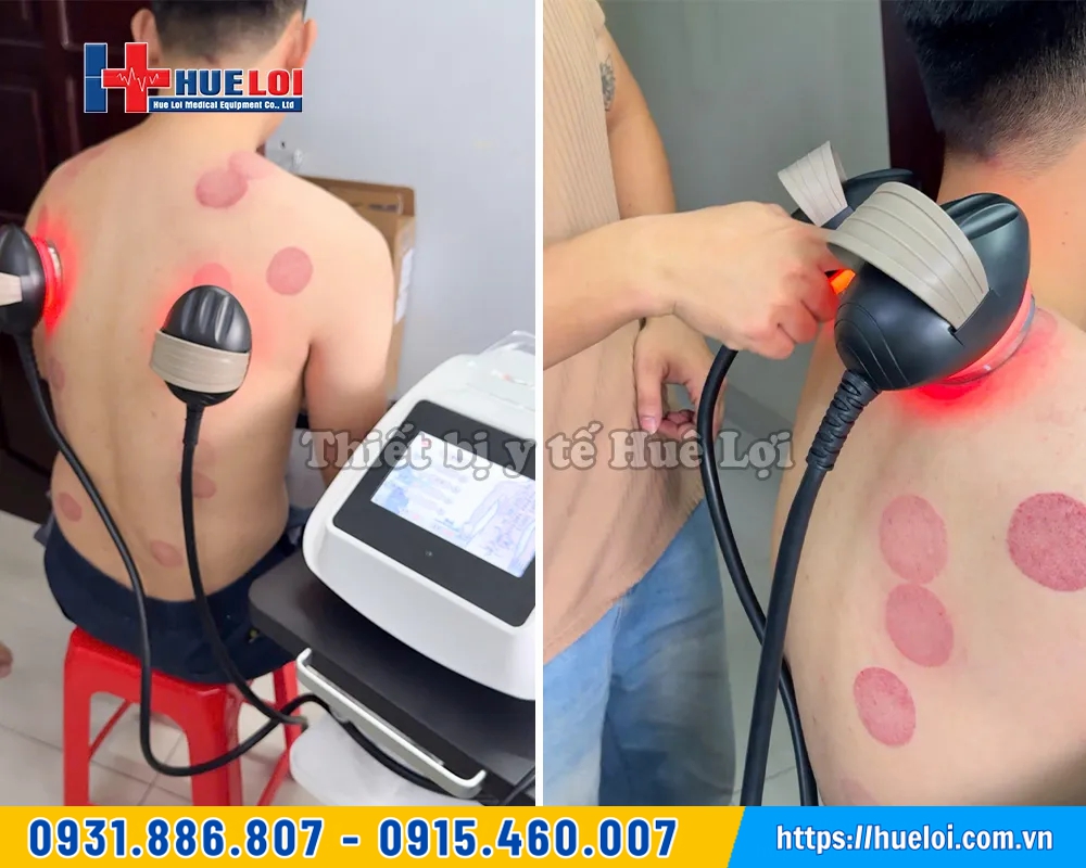 máy điện sinh học có giác hơi