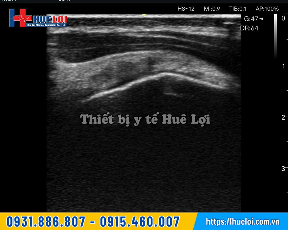chất lượng hình ảnh siêu âm L12