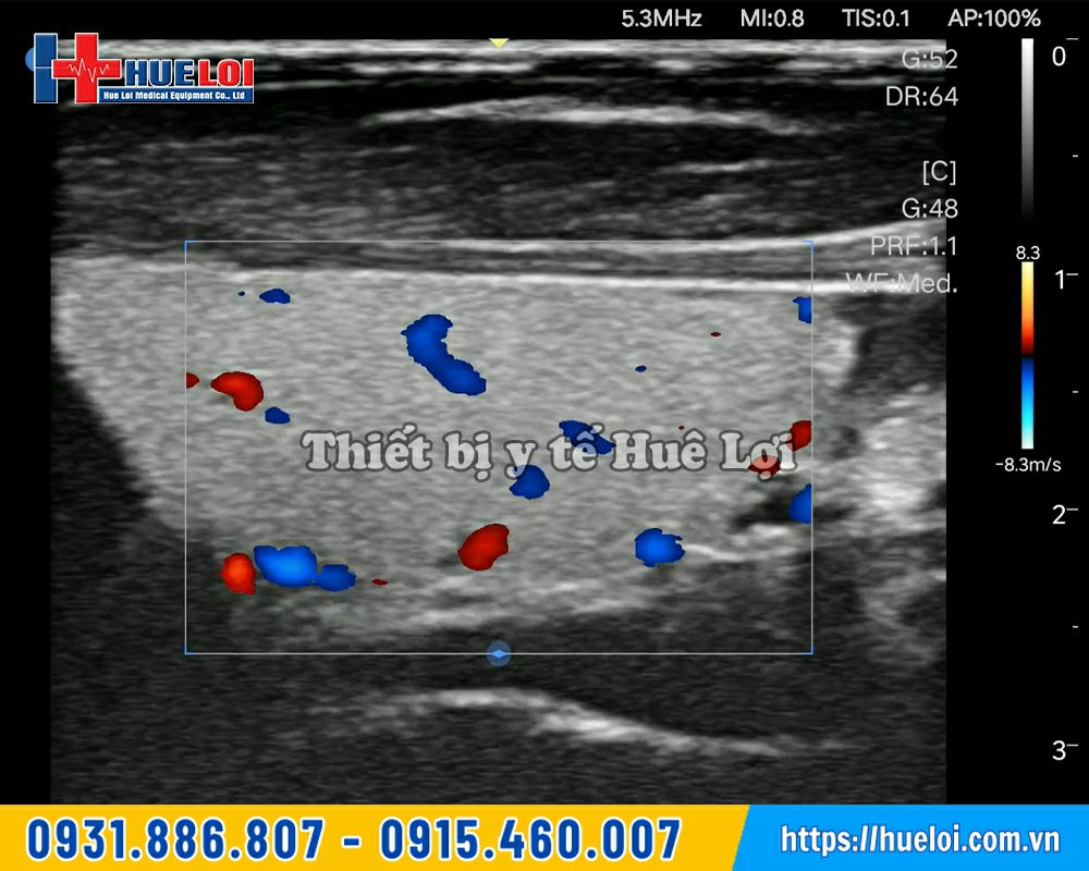 hình ảnh siêu âm thực tế của máy l12