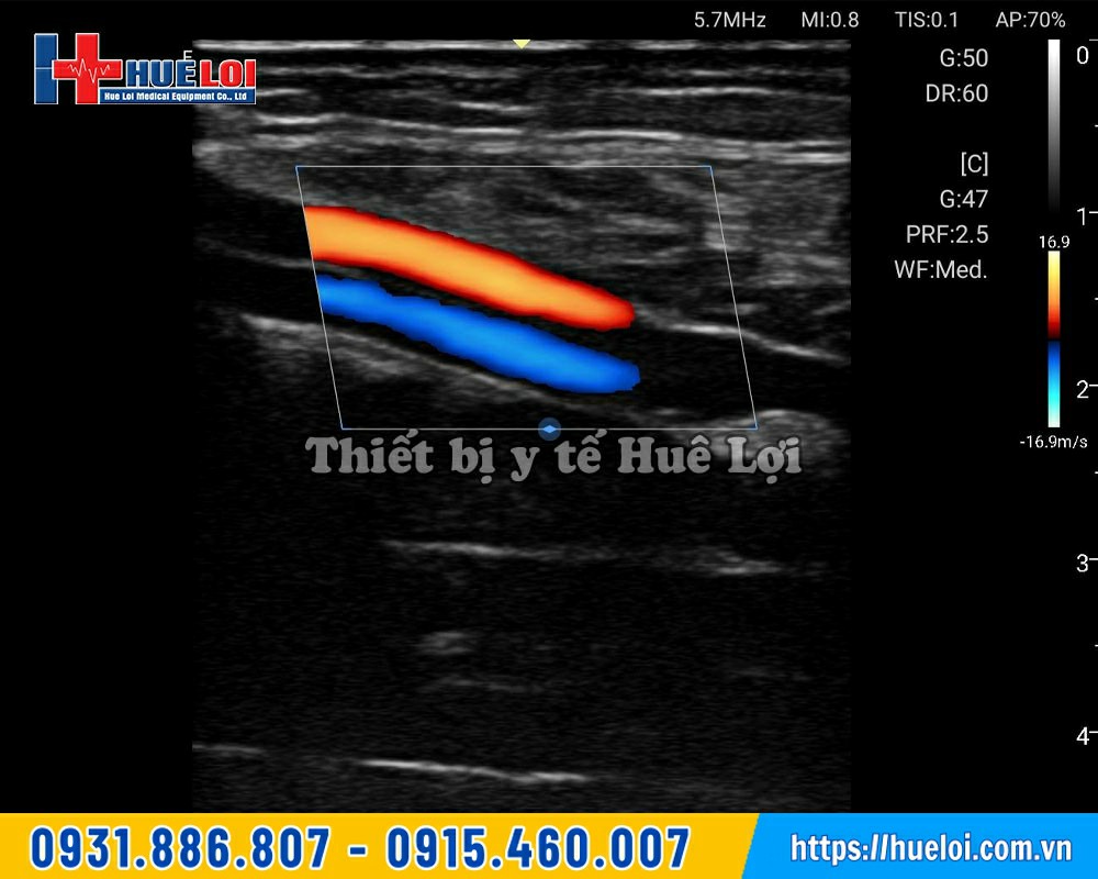 Hình ảnh máy siêu âm Edan L12 thực tế khi siêu âm