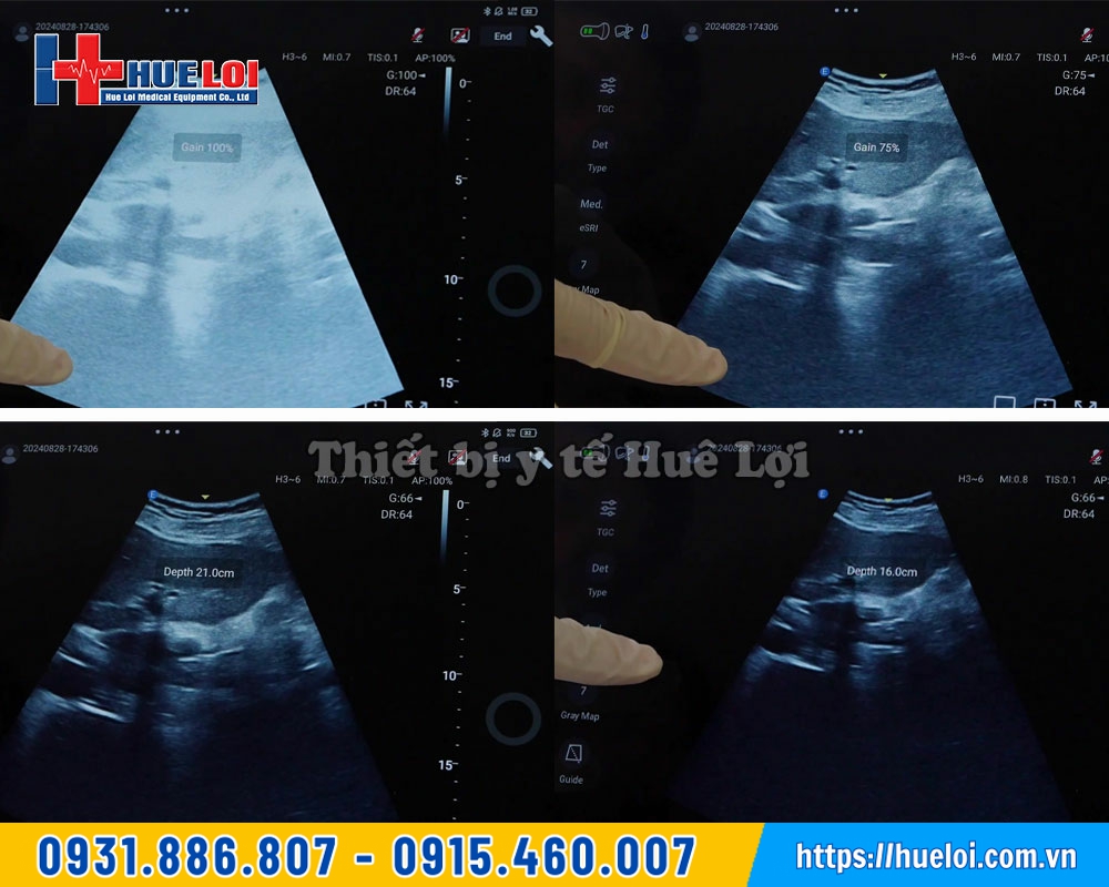 chất lượng hình ảnh máy siêu âm C5 exp