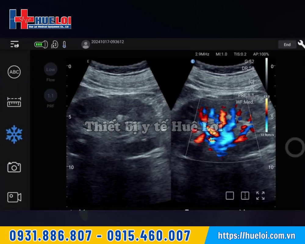 Hình ảnh thực tế từ máy siêu âm cầm tay EDAN Nano C5 EXP
