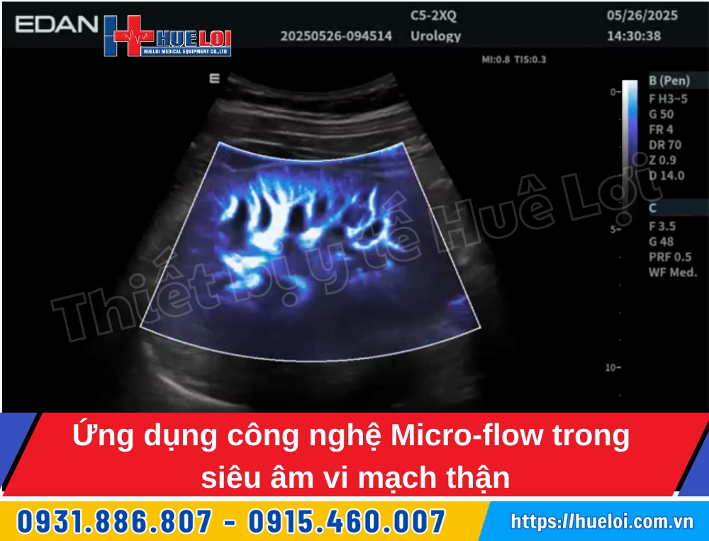 máy siêu âm vi mạch thận edan lx85