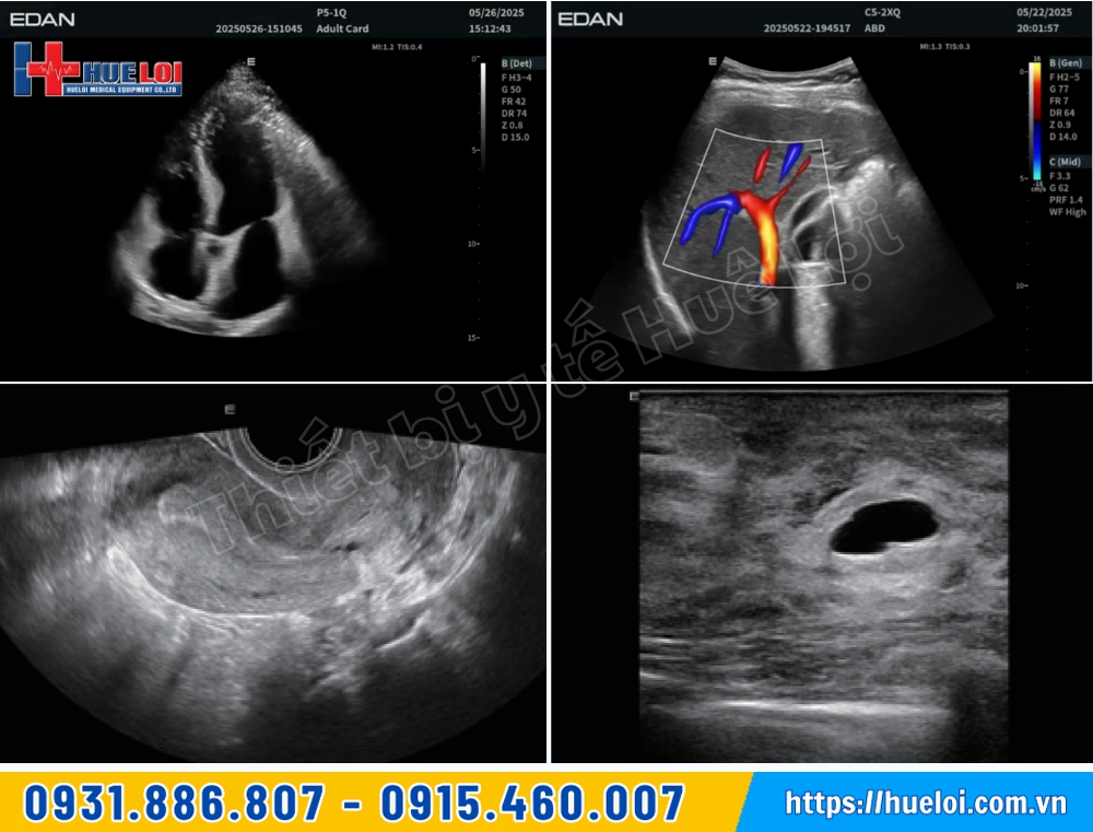 máy siêu âm lx 85 edan