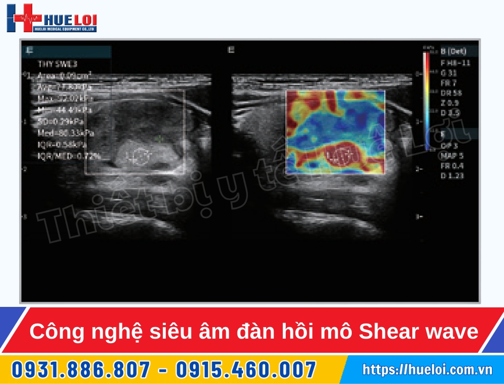 máy siêu âm 5d edan lx85