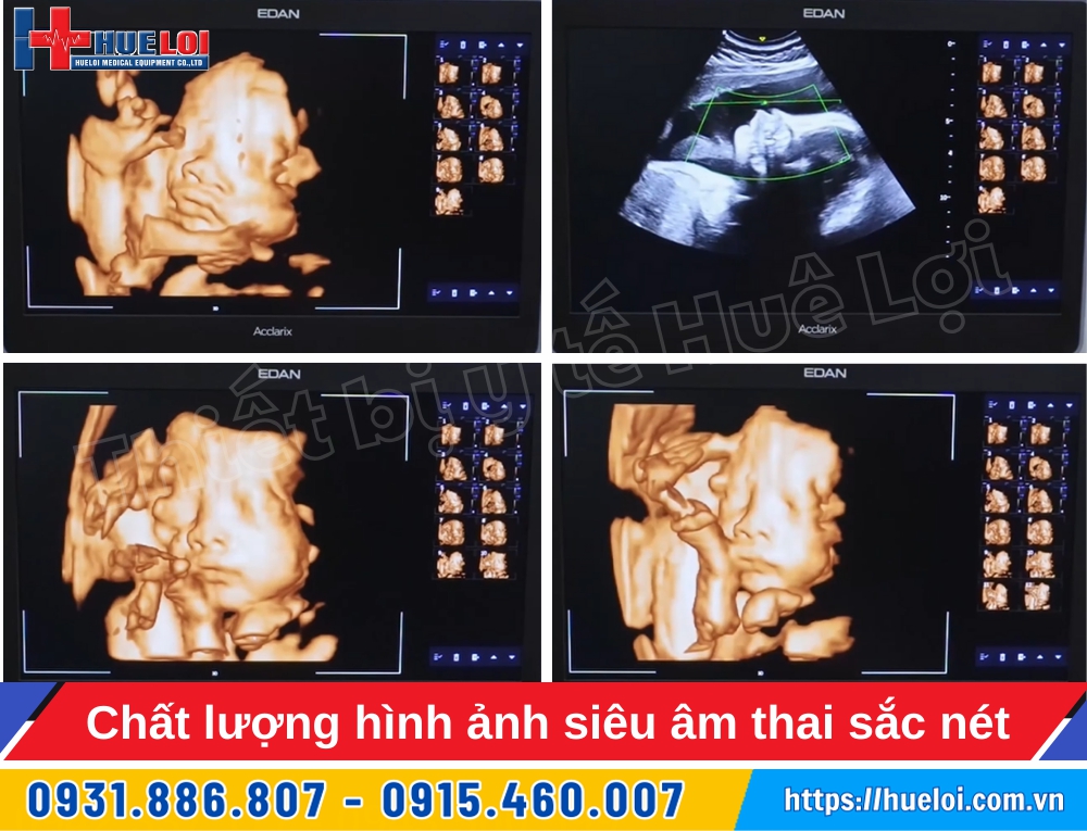 máy siêu âm sản khoa edan lx85