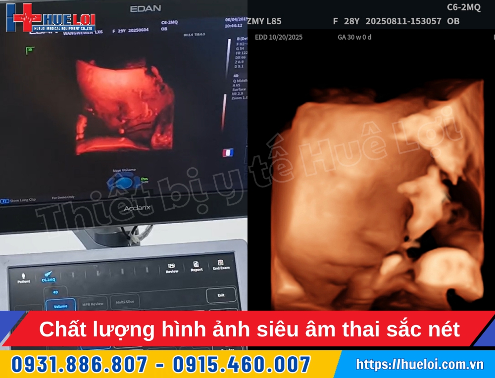 máy siêu âm sản khoa edan lx85