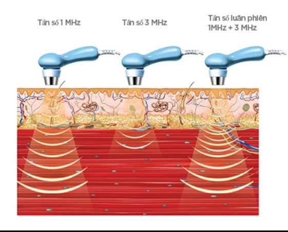 các tần số sóng siêu âm trị liệu