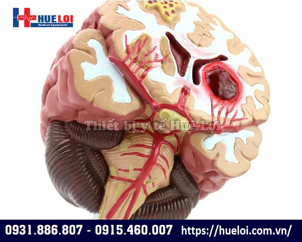 Mô hình dị dạng mạch não