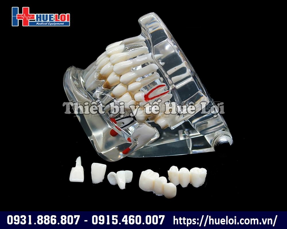 mô hình răng implan
